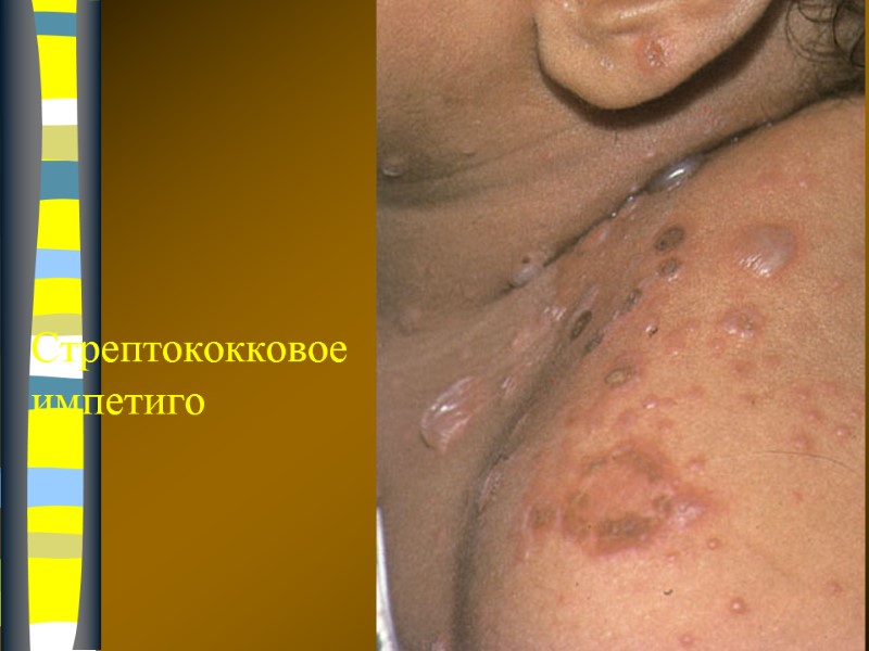 Стрептококковое  импетиго